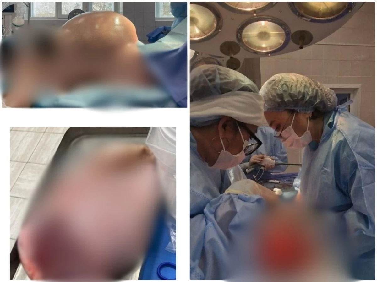 Павлодарлық әйелдің денесінен 19 литр болатын үлкен ісік алып тасталды