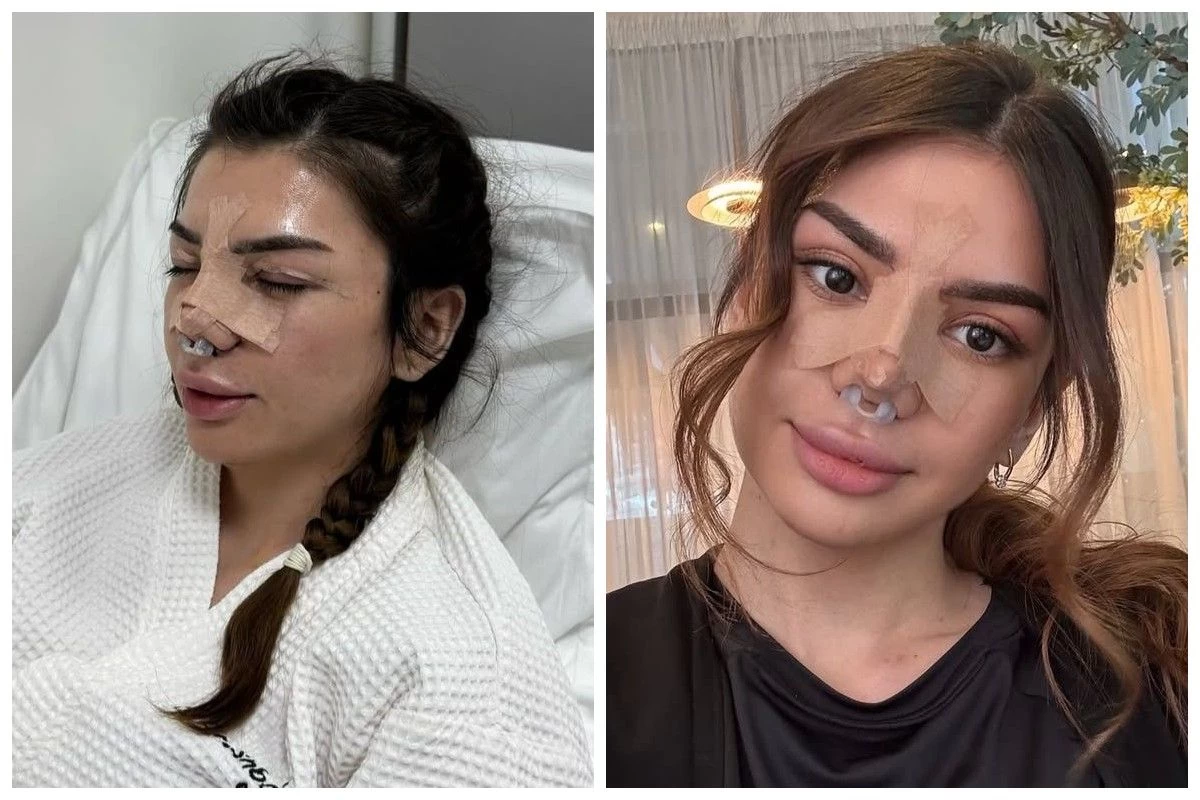 Қазақстандық трансгендер Ника Нетт бет-әлпетін өзгертті