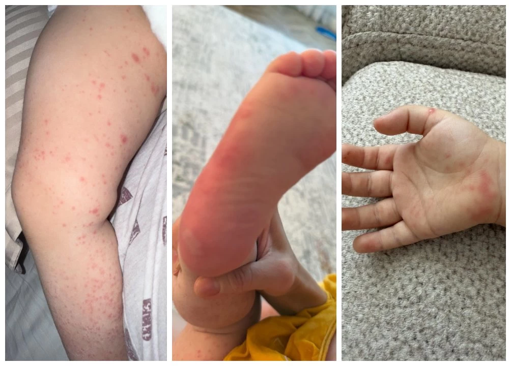 Қазақстанда энтеровирус өршіп тұр